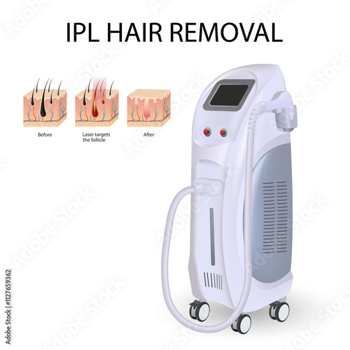 Laser hair removes the skin layer and follicles for beauty and smoothness of the body. Hair removal procedure