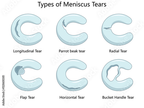 meniscus tears, including longitudinal, radial, parrot beak, flap, horizontal, and bucket handle tears diagram hand drawn schematic vector illustration. Medical science educational illustration