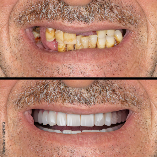 Full-arch dental prosthesis with the All on Four and All on X treatment concept for edentulous jaws in dental implant treatment. Dental X ray image and dental before and after smile design. photo