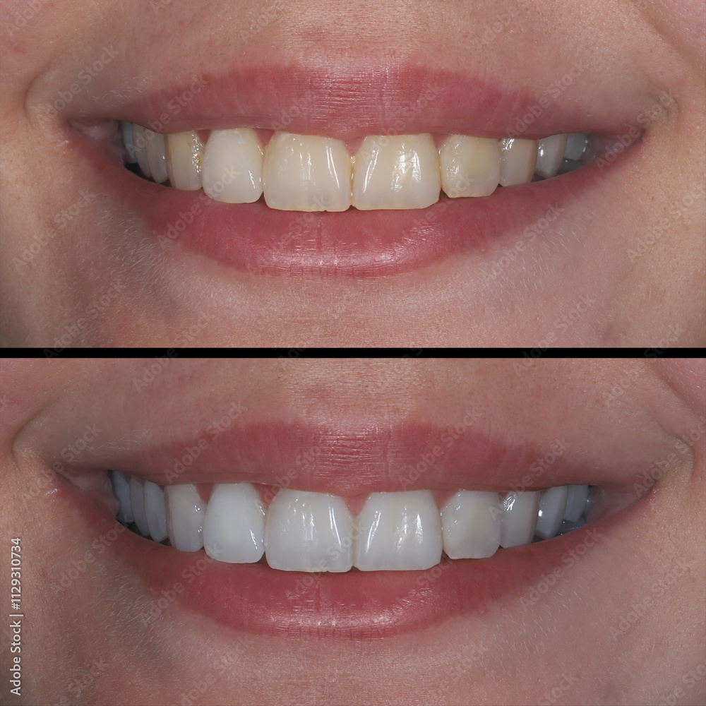 Fototapeta premium Full arch teeth whitening performed by dentists in a clinical setting within dental aesthetic dentistry.