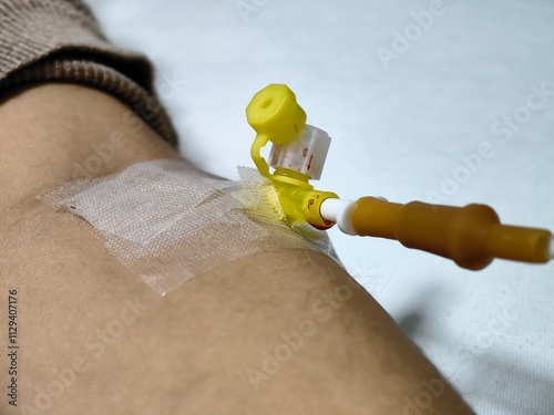 Arm with infusion with intravenous saline drip. Intravenous set saline drip on patient hand in the hospital