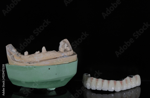 Full-arch porcelain implant-supported dental prosthesis for edentulous jaws with All-on-X and All-on-4 treatment procedure using dental implant surgery.