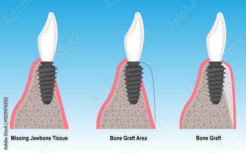 Photography Bone grafting treatment for bone tissue loss and resorption in dental implant treatment