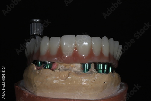 Full-arch porcelain implant-supported dental prosthesis for edentulous jaws with All-on-X and All-on-4 treatment procedure using dental implant surgery.