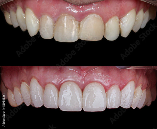 Aesthetic smile design treatment in dental dentistry. Dental treatment with laminate veneers, dental implants, and porcelain crowns. Smile makeover and dental before and after. 
