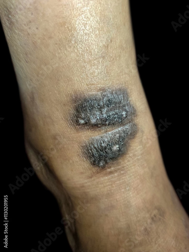 Closeup of a dry, scaly eczema patch with discoloration on the foot. photo