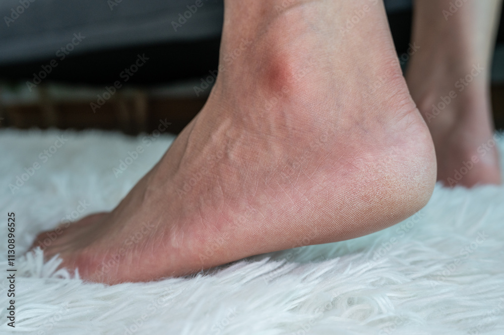 Naklejka premium Cropped shot view of person foot with cracked heel problem. Cracked heels occur when dry, thick skin on the bottom of your heels cracks and splits.