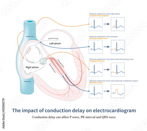 Electric impulses can be conducted, but the conduction speed slows down, resulting in conduction delay and affecting the morphology of the P wave, PR interval, and QRS wave.