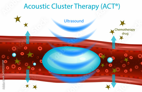 Acoustic Cluster Therapy or ACT. Therapeutic ultrasound. Sonodynamic therapy photo