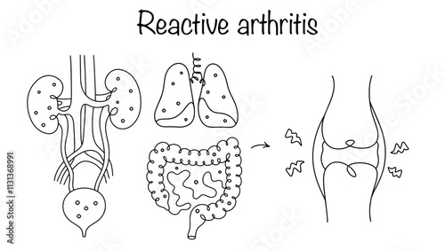Reactive arthritis