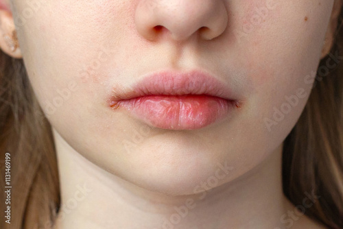 Close-up of dry and chapped lips with visible irritation. A close-up view of a person's lips showing dryness, chapping, and visible irritation at the corners of the mouth.