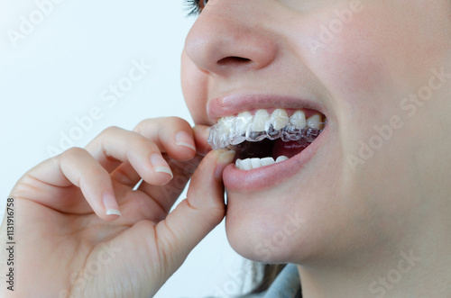 Mujer colocándose alineadores dentales invisibles. Tratamiento de ortodoncia invisalign removible. 