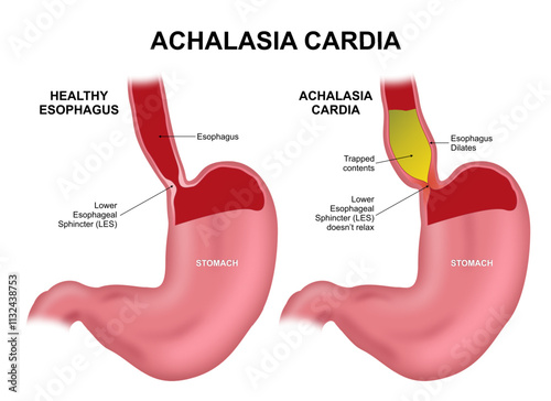 Achalasia cardia human stomach illustration cross section