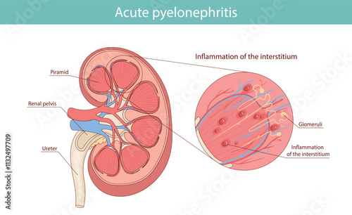 Acute pyelonephritis of the kidney. vector medical illustration