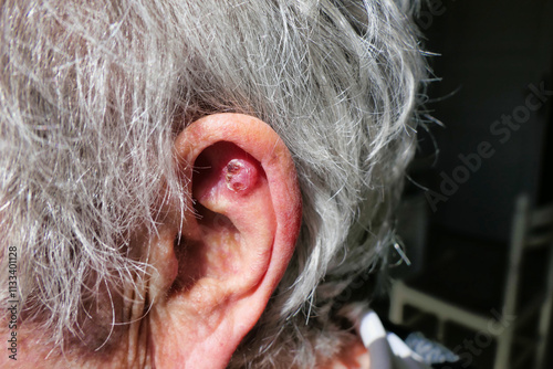 Basal Cell Carcinoma of the skin located inside the ear lobe necessitating the need for an operation.
