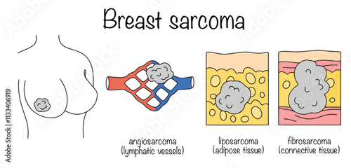 Breast sarcoma photo