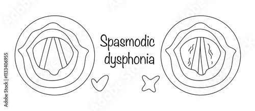 Spasmodic dysphonia