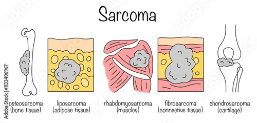 Sarcoma