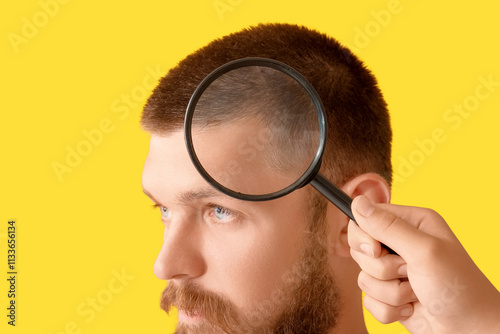 Young man with hair loss pr...