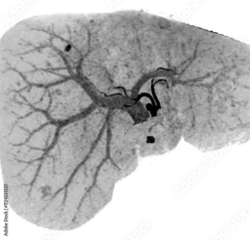 CT angiogram scan of liver. Liver sirrosis. Choresterol reduction. 3D CT liver angiography, or 3D helical CT angiography photo