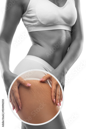 A woman after weight loss shows stretch marks on the skin of her legs and the outer and inner side of the thighs. Treatment of skin stretch marks in the clinic.