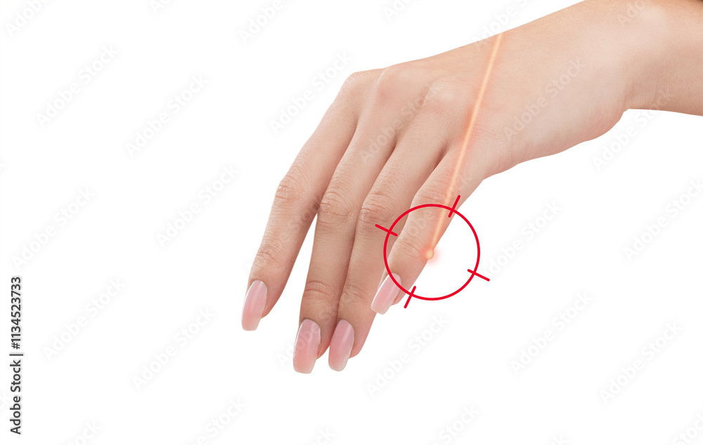 A woman has a wart on her little finger. Treatment of warts with liquid nitrogen. A woman has a wart on her little finger. Treatment of warts with liquid nitrogen.
