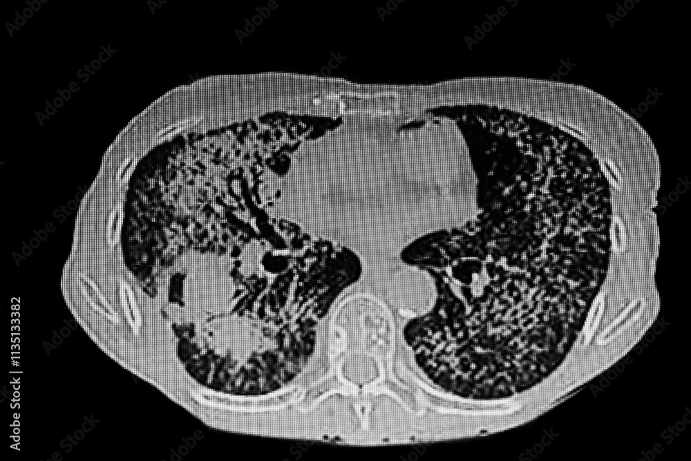 Medical themes: Chest CT Scan of lung cancer (Adenocarcinoma) with miliary pattern.