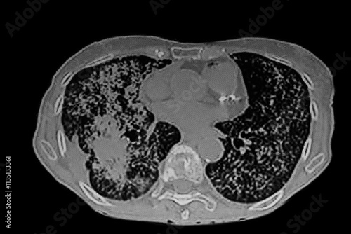 Medical themes: Chest CT Scan of lung cancer (Adenocarcinoma) with  miliary pattern.