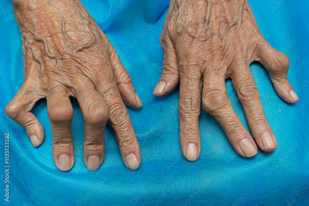 Medical themes: Senior woman hands with Rheumatoid Arthritis