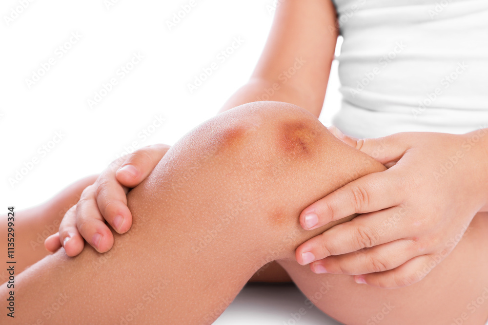 Child with bruise on leg against white background, closeup