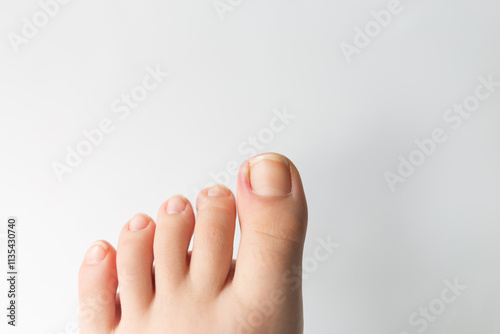Obraz na plátně ingrown toenail on a child's foot, medical issue, discomfort.