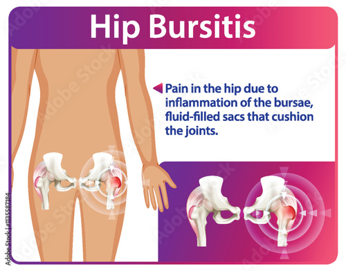 Understanding Hip Bursitis and Its Effects