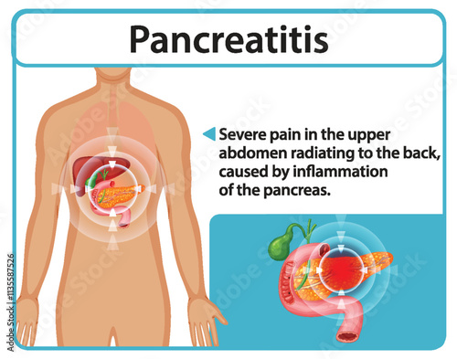 Understanding Pancreatitis and Its Symptoms