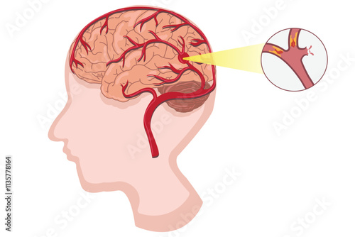 Illustration of hemorrhagic stroke showing blocked brain artery and blood clot. eps 10