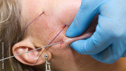Close-up anti-age facial lifting procedure using PDO threads of polylactic acid applied in the face with aseptic cannula before extending skin