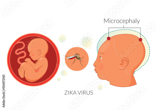 Zika Virus risk during Pregnancy  - Stock Illustration