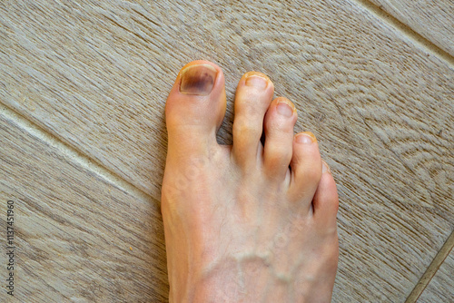 Runner's Feet: Black Toenails from Athletic Trauma. Barefoot Athlete's Feet Displaying Common Sports Injury