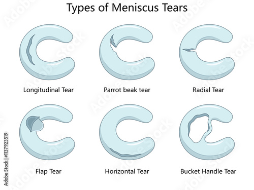 meniscus tears, including longitudinal, radial, parrot beak, flap, horizontal, and bucket handle tears diagram hand drawn schematic raster illustration. Medical science educational illustration