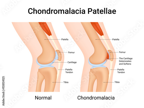 Symptoms of the Chondromalacia Patellae