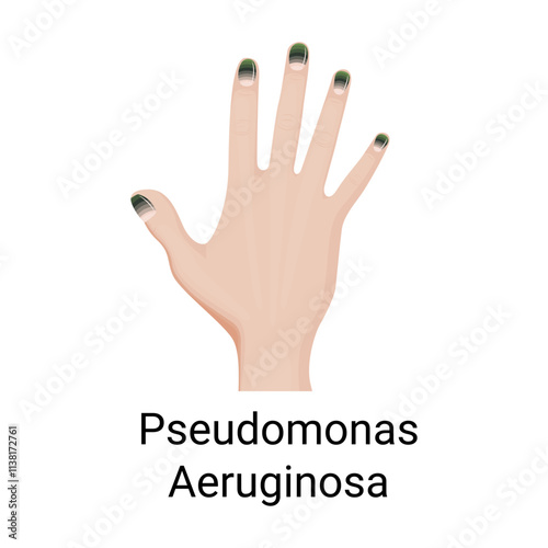 Green Nail Syndrome, fingernail chloronychia symptom