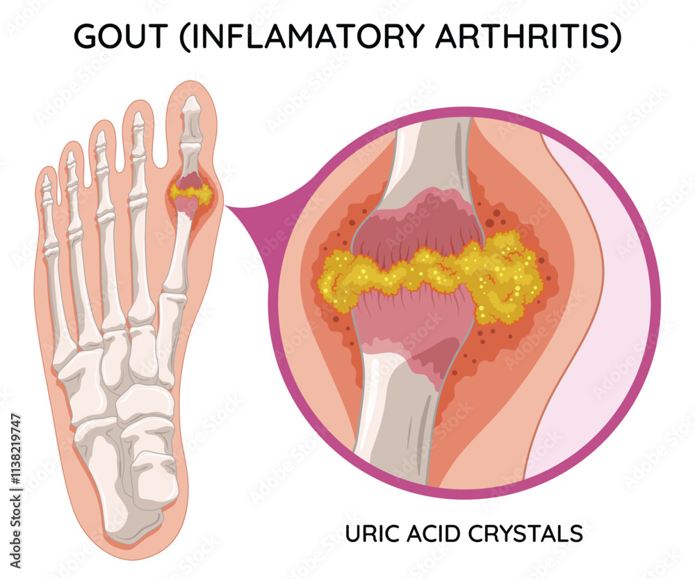 Gout diagram in human foot with crystallization of uric acid joint. Medical educational poster infographic scheme with inflammatory arthritis. Orthopedic disease vector illustration