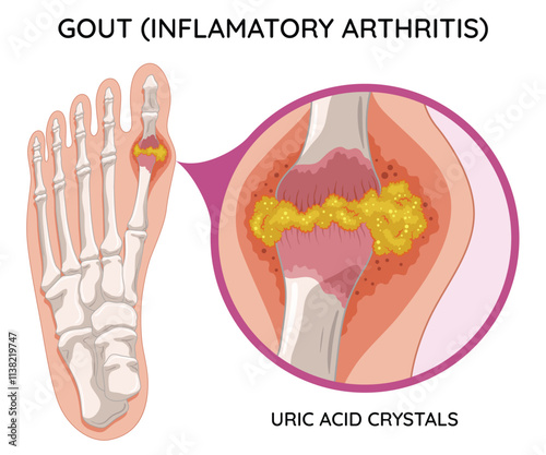 Obraz na płótnie Gout diagram in human foot with crystallization of uric acid joint. Medical educational poster infographic scheme with inflammatory arthritis. Orthopedic disease vector illustration w salonie
