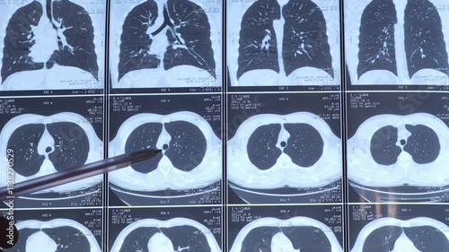 Doctor learning CT scans of lung diseases. MRI for diagnosis chest healthcare.