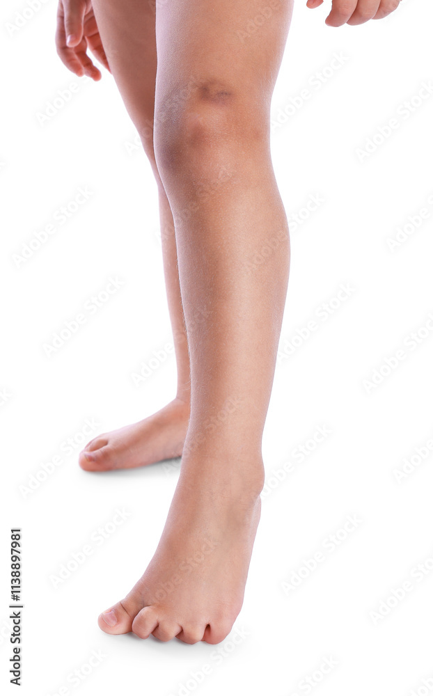 Child with bruise on leg against white background, closeup Child with bruise on leg against white background, closeup