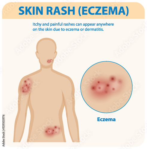 Understanding Eczema and Skin Rashes