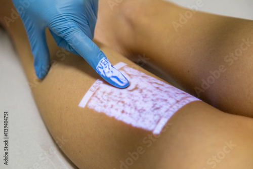 laser view of varicose veins, medicine, doctors, trombosis.