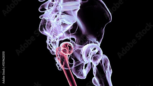 3D animation of human hip bones showing Legg-Calve-Perthes disease, a childhood condition where blood supply loss causes femoral head degeneration.