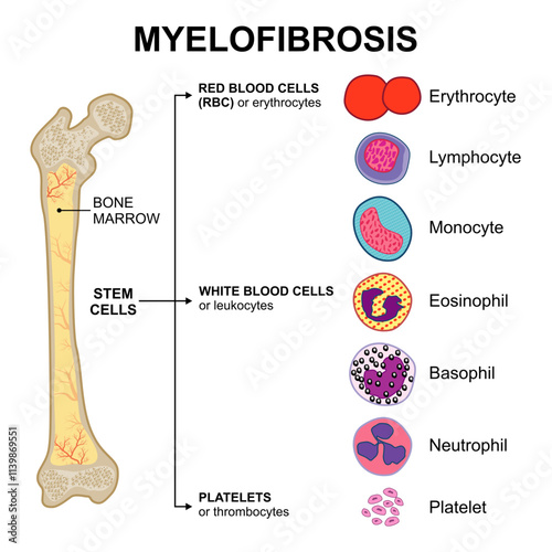 Myelofibrosis bone marrow blood cancer illustration