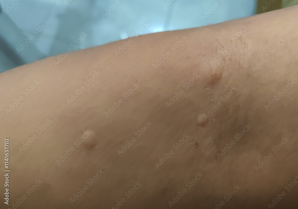 Fototapeta premium Itchy skin due to mosquito bites.