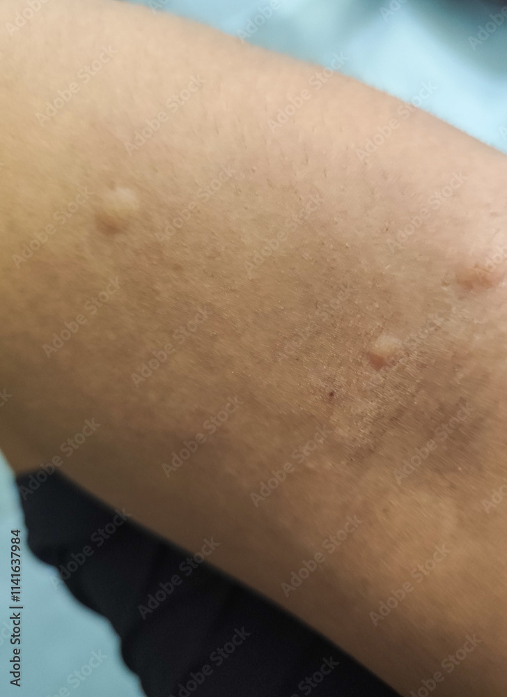 Fototapeta premium Itchy skin due to mosquito bites.